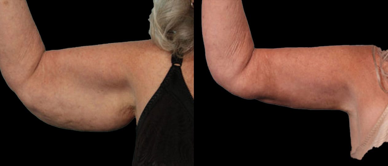 A result from Marietta Plastic Surgery