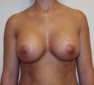 Mitchell Plastic Surgery breast augmentation after — Henderson, NV