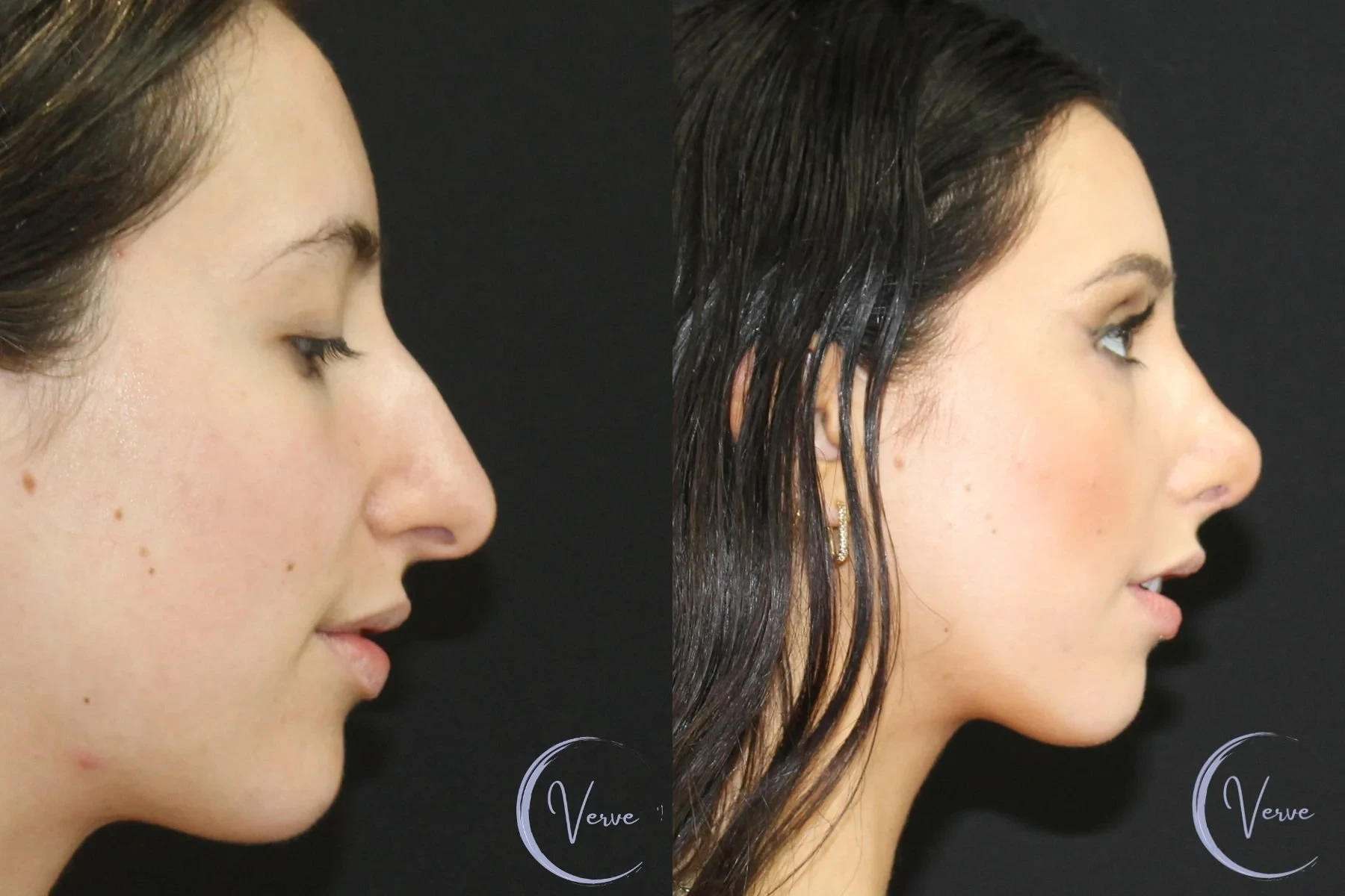 A result from Verve Plastic Surgery
