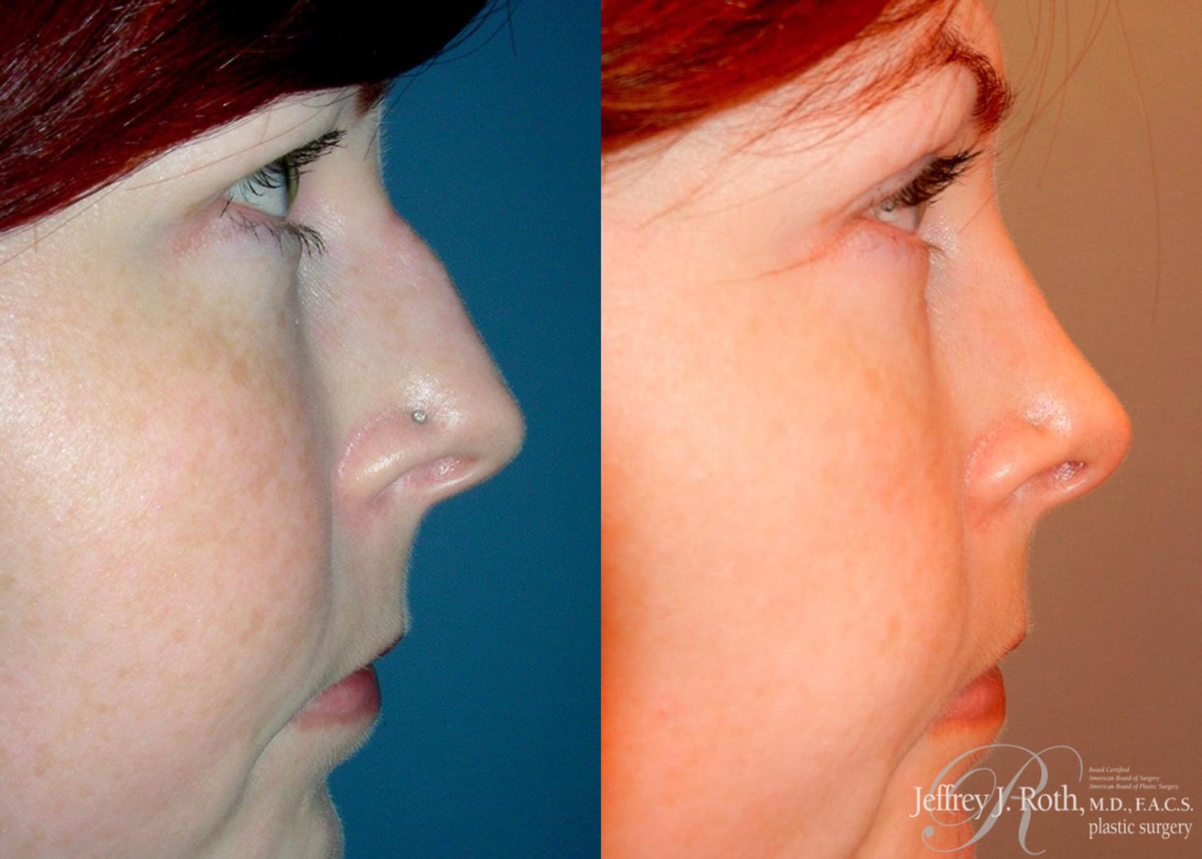 Rhinoplasty result at Jeffrey J. Roth, MD Plastic Surgery