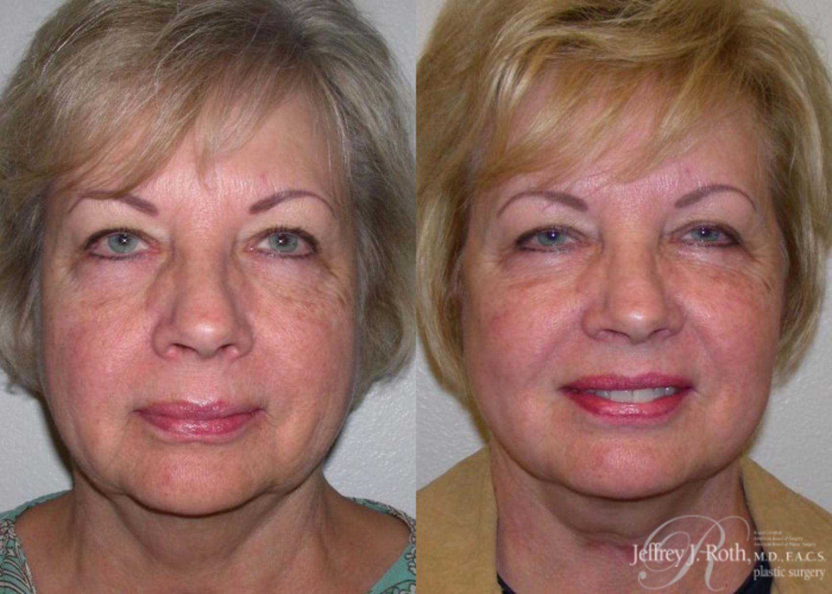 Facelift result at Jeffrey J. Roth, MD Plastic Surgery