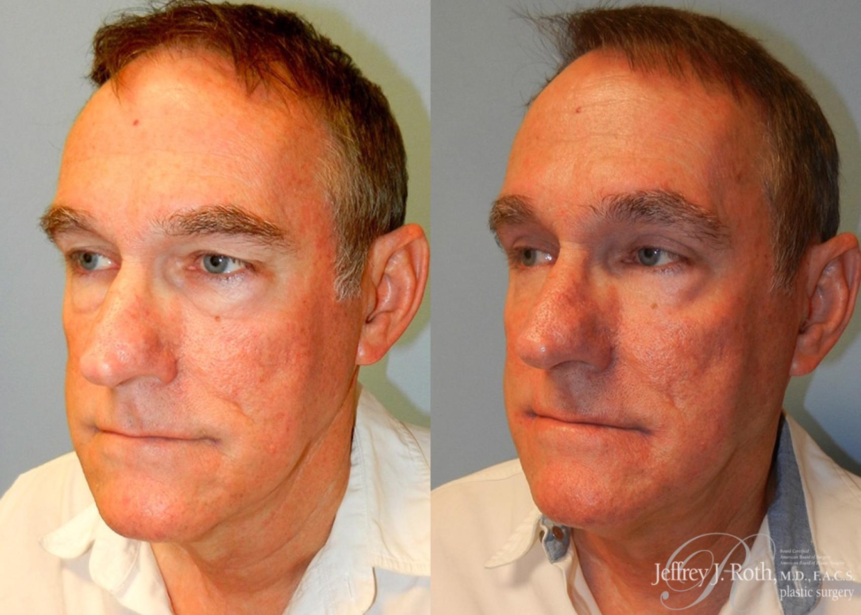 Blepharoplasty result at Jeffrey J. Roth, MD Plastic Surgery