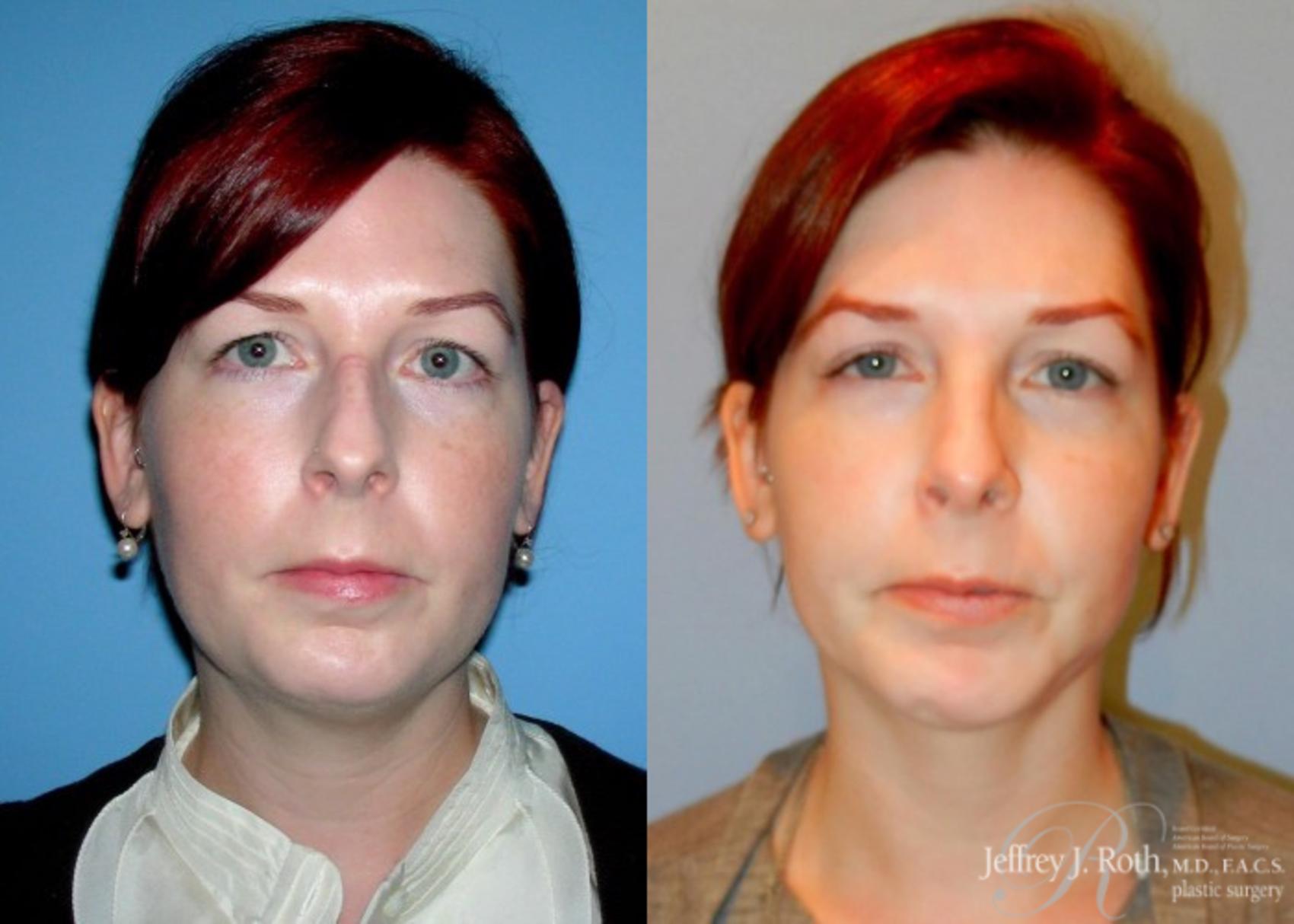 Liposuction result at Jeffrey J. Roth, MD Plastic Surgery