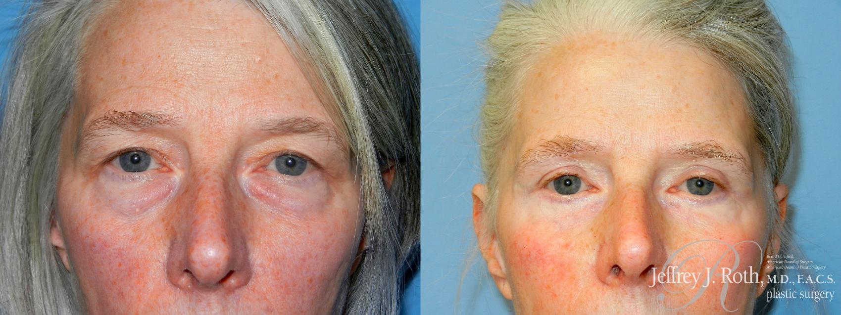 Blepharoplasty result at Jeffrey J. Roth, MD Plastic Surgery