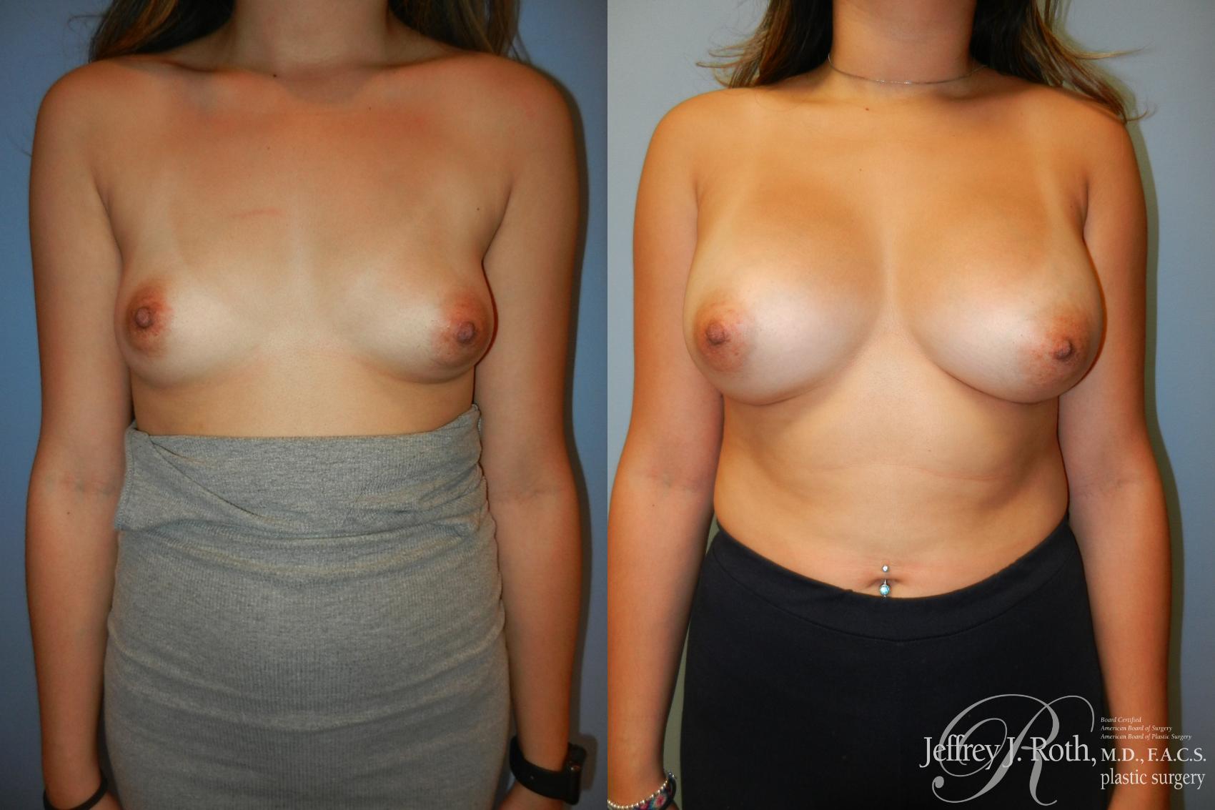 Breast Augmentation result at Jeffrey J. Roth, MD Plastic Surgery