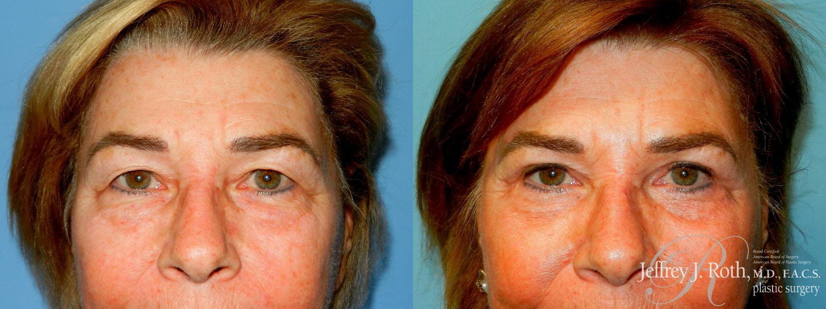 Blepharoplasty result at Jeffrey J. Roth, MD Plastic Surgery