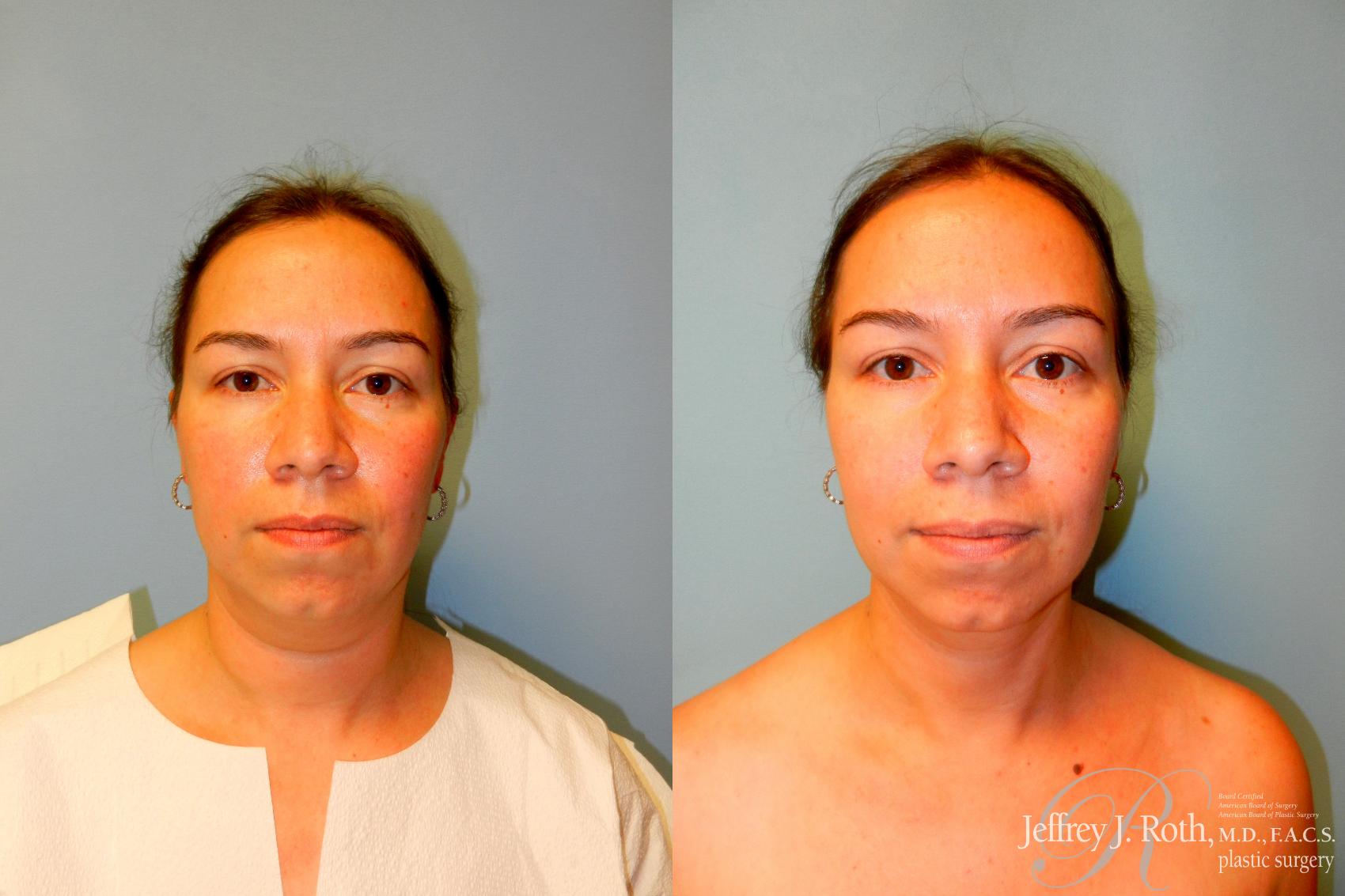 Liposuction result at Jeffrey J. Roth, MD Plastic Surgery
