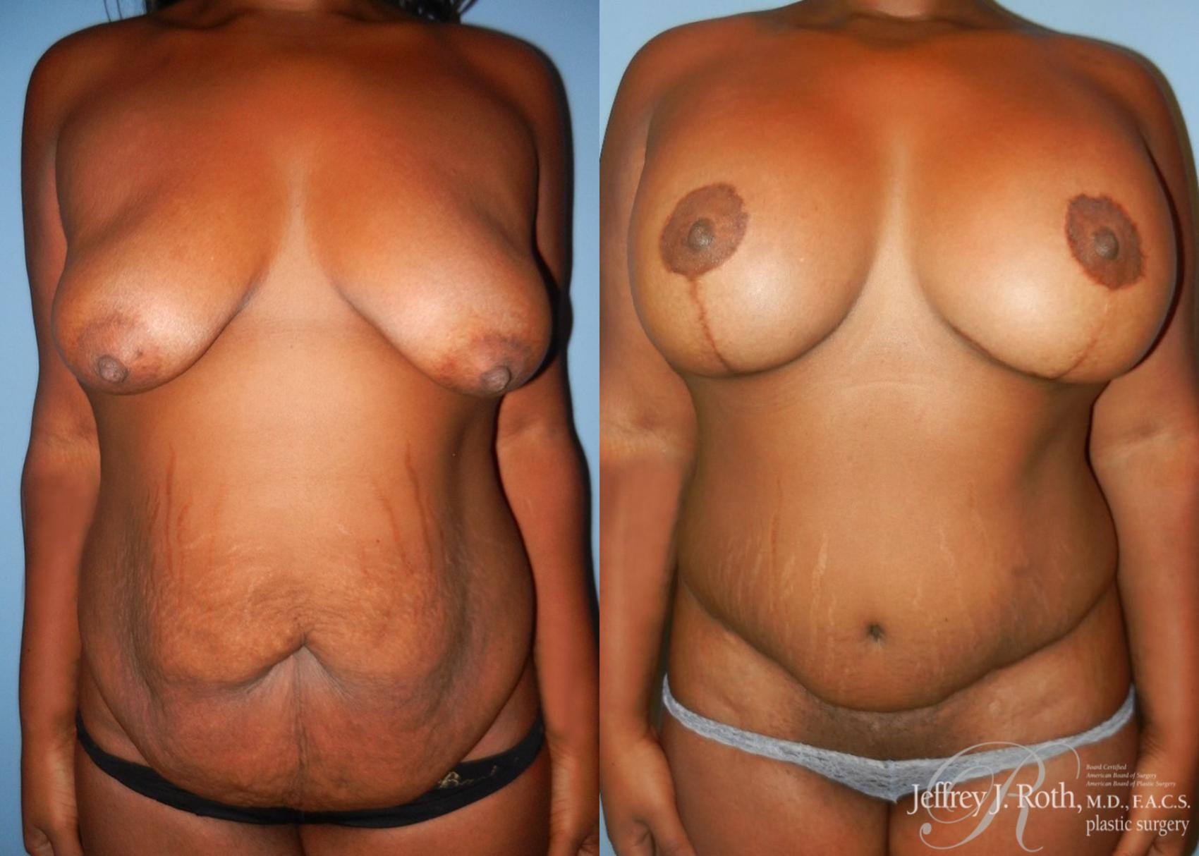 Mommy Makeover result at Jeffrey J. Roth, MD Plastic Surgery