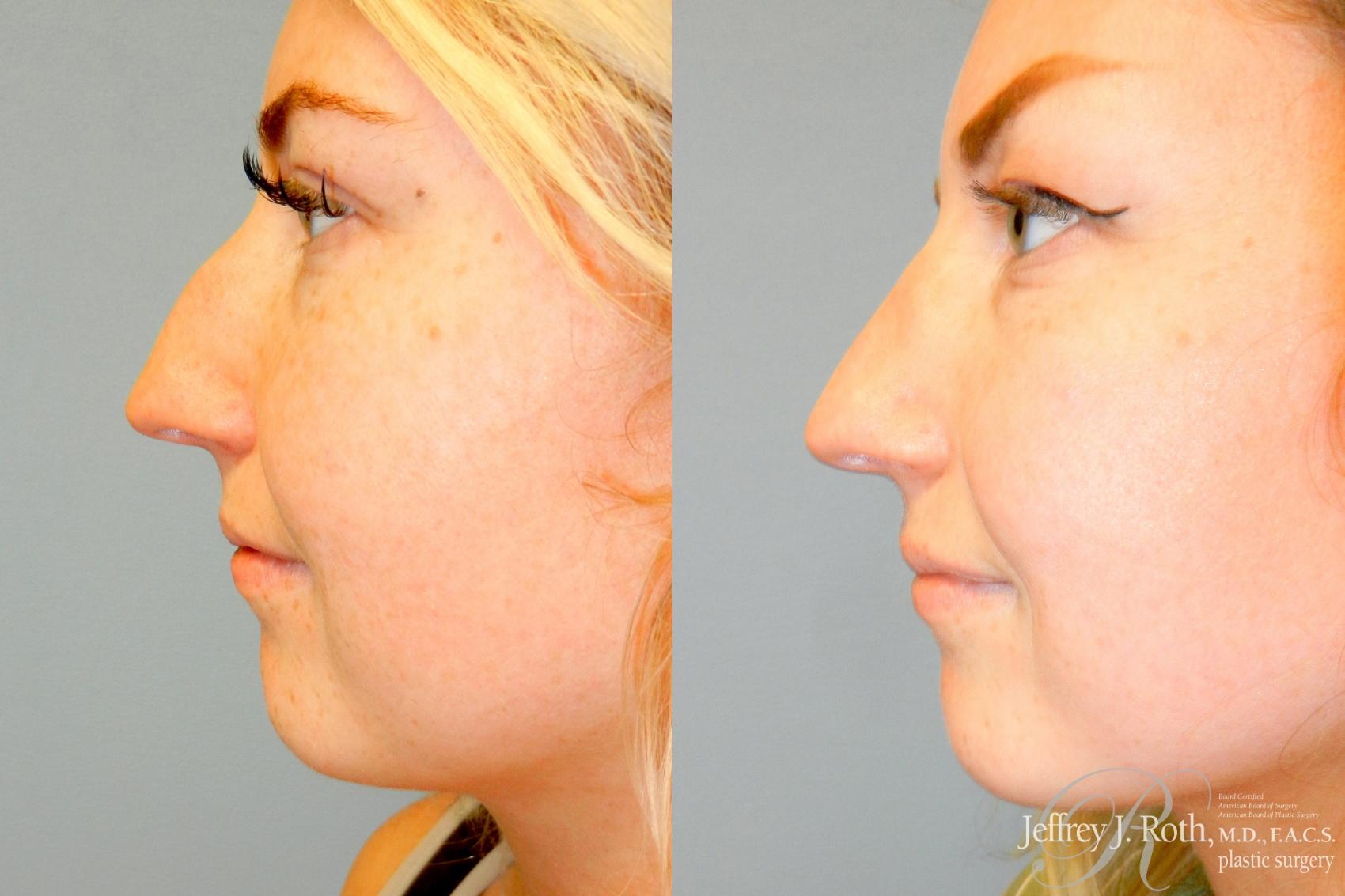 Rhinoplasty result at Jeffrey J. Roth, MD Plastic Surgery