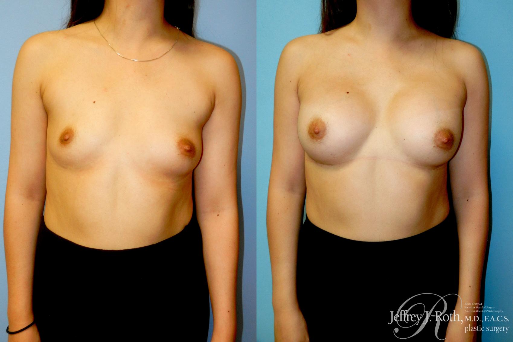 Breast Augmentation result at Jeffrey J. Roth, MD Plastic Surgery