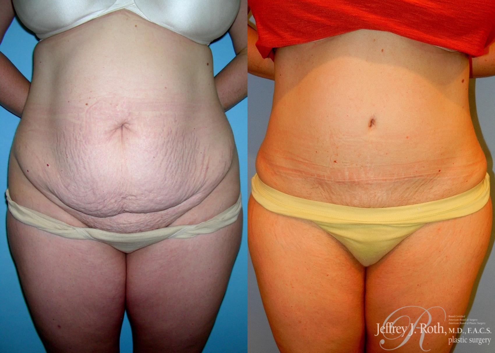 Tummy Tuck result at Jeffrey J. Roth, MD Plastic Surgery
