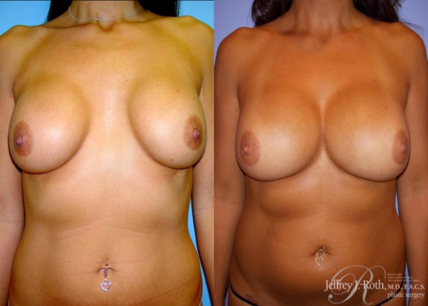 Implant Revision result at Jeffrey J. Roth, MD Plastic Surgery