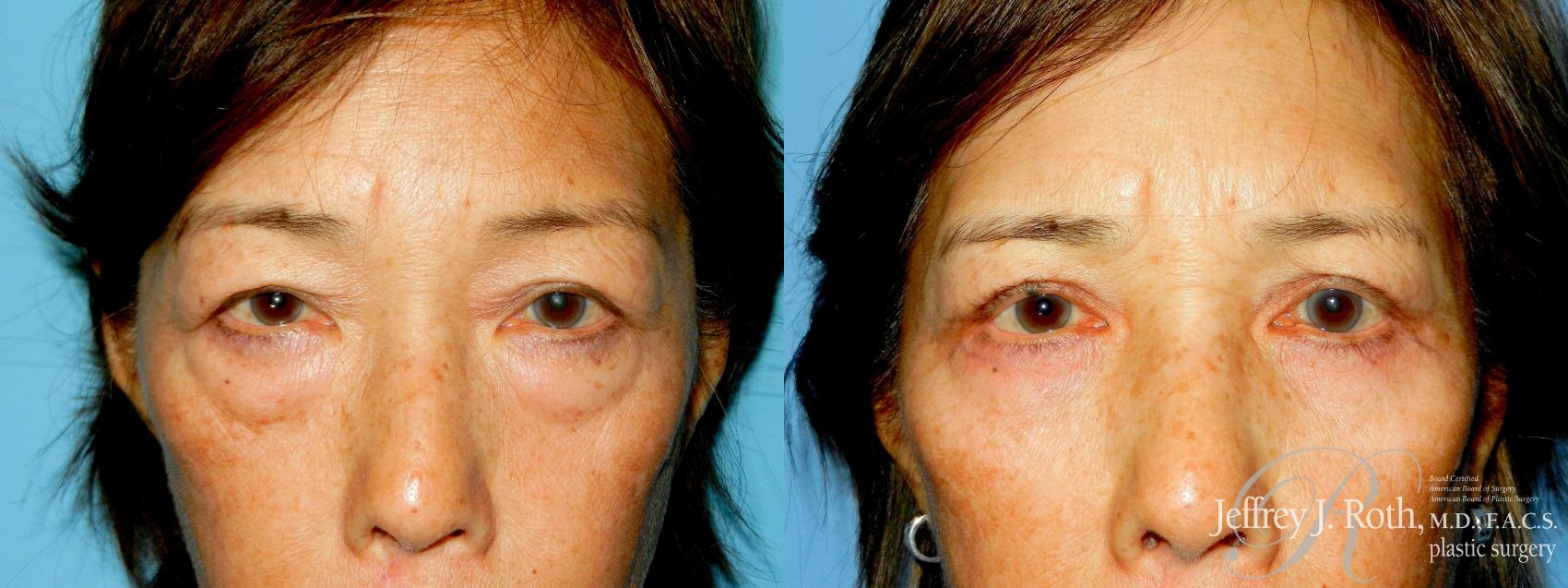 Blepharoplasty result at Jeffrey J. Roth, MD Plastic Surgery