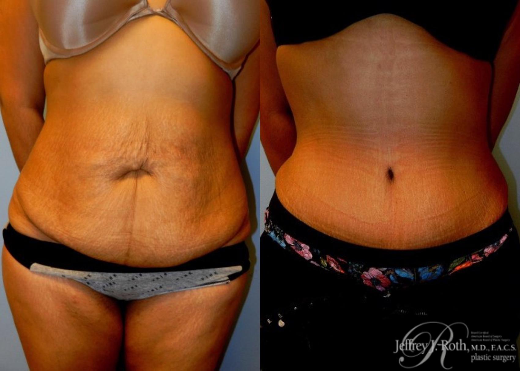 Tummy Tuck result at Jeffrey J. Roth, MD Plastic Surgery