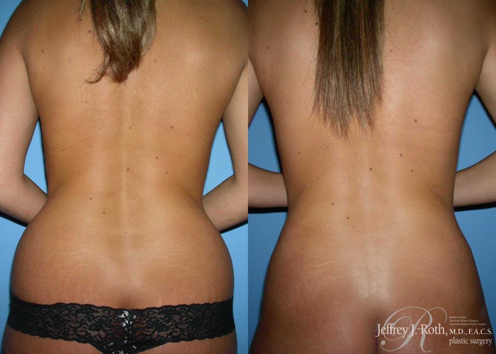 Liposuction result at Jeffrey J. Roth, MD Plastic Surgery