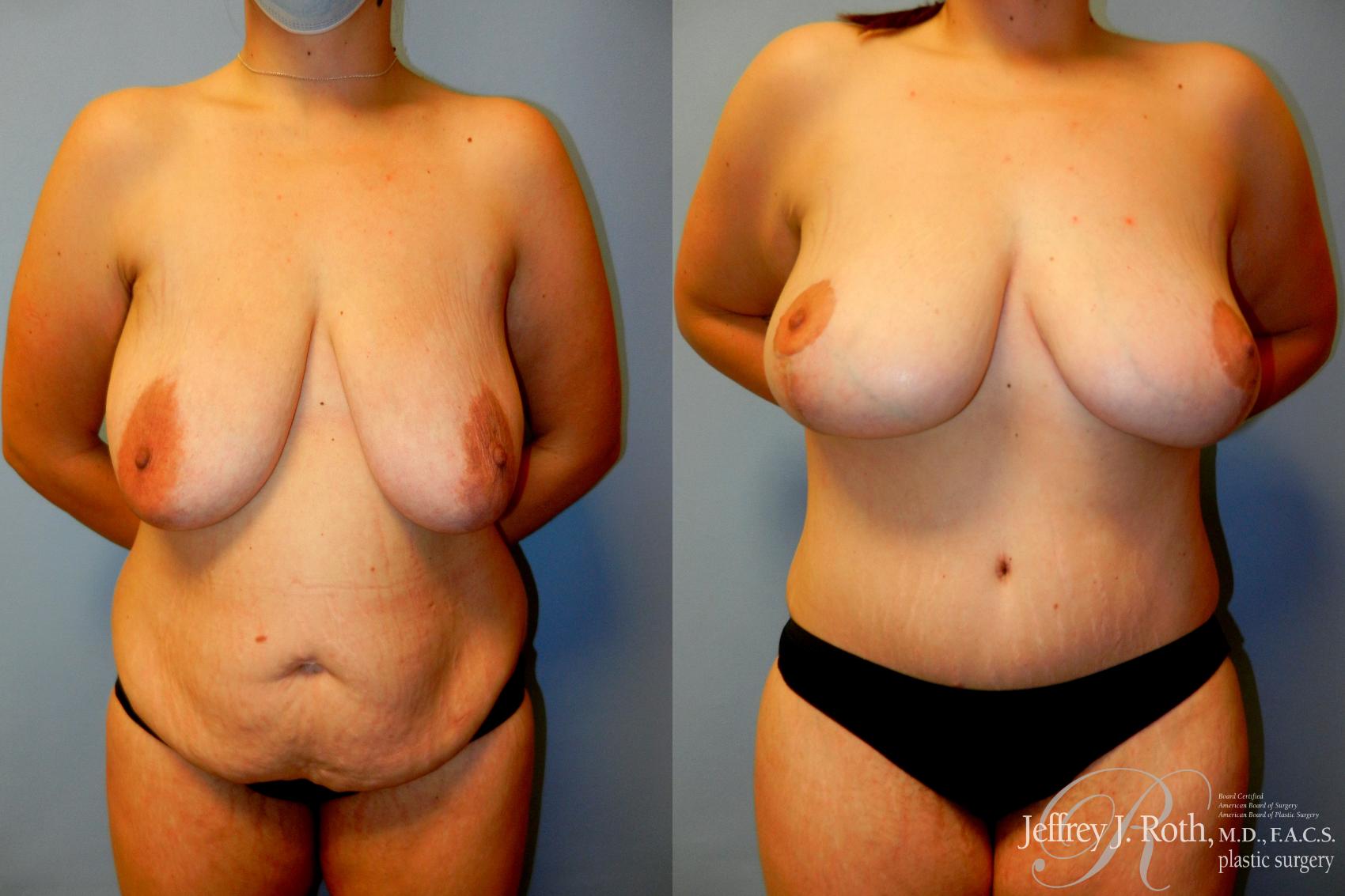 Mommy Makeover result at Jeffrey J. Roth, MD Plastic Surgery