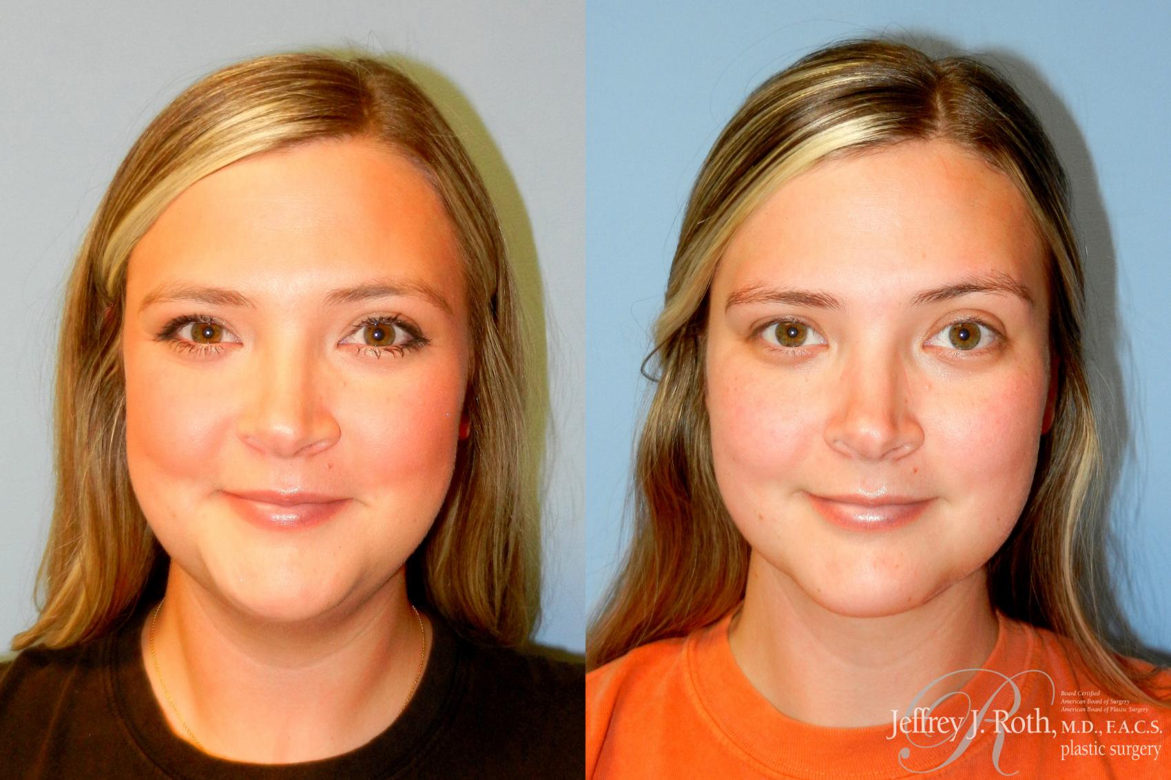 Liposuction result at Jeffrey J. Roth, MD Plastic Surgery