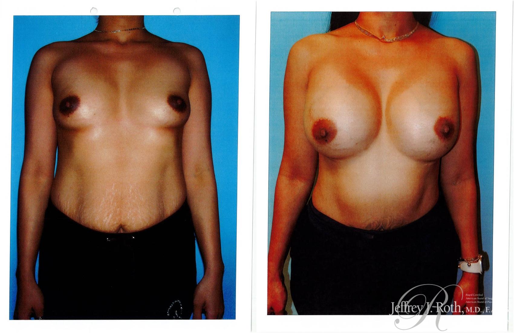 Breast Augmentation result at Jeffrey J. Roth, MD Plastic Surgery