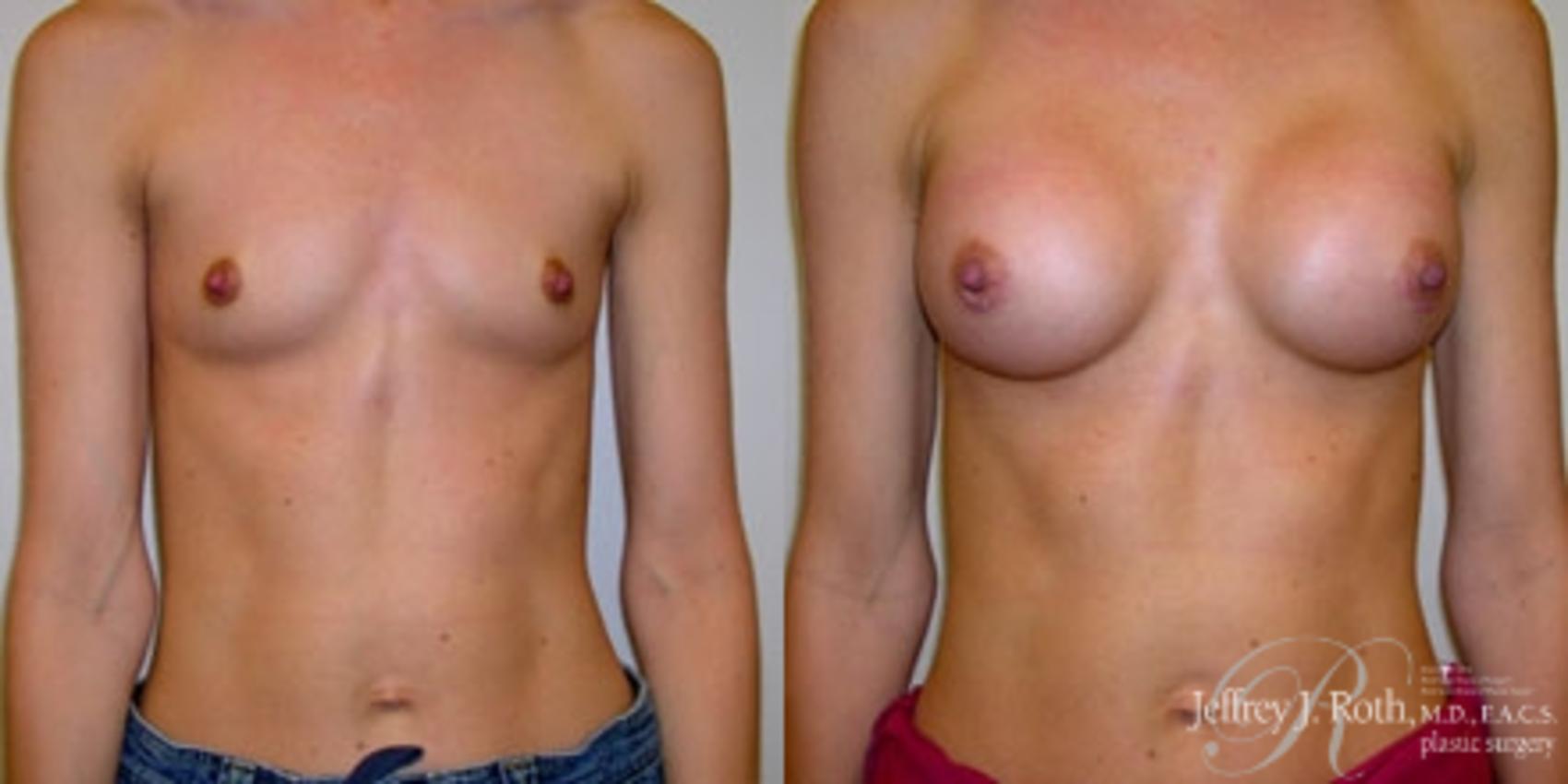 Breast Augmentation result at Jeffrey J. Roth, MD Plastic Surgery