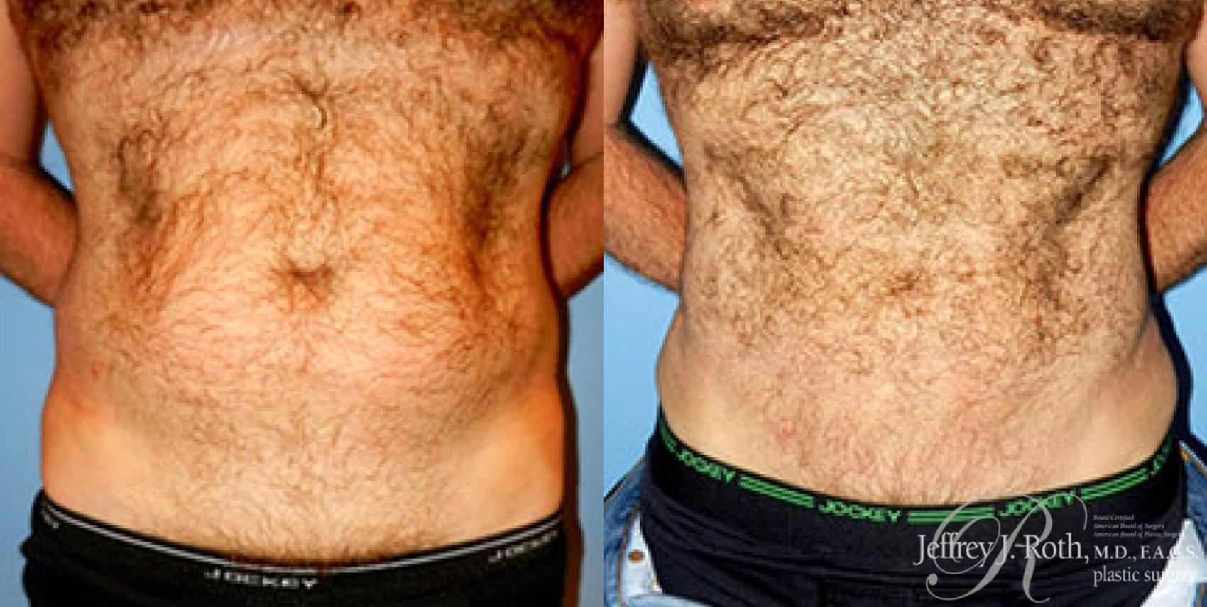 Liposuction result at Jeffrey J. Roth, MD Plastic Surgery