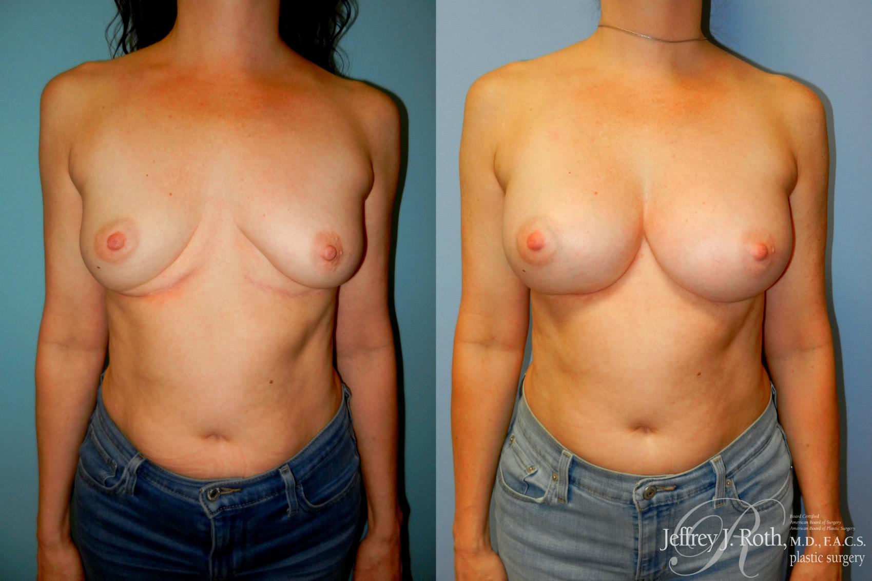 Implant Revision result at Jeffrey J. Roth, MD Plastic Surgery
