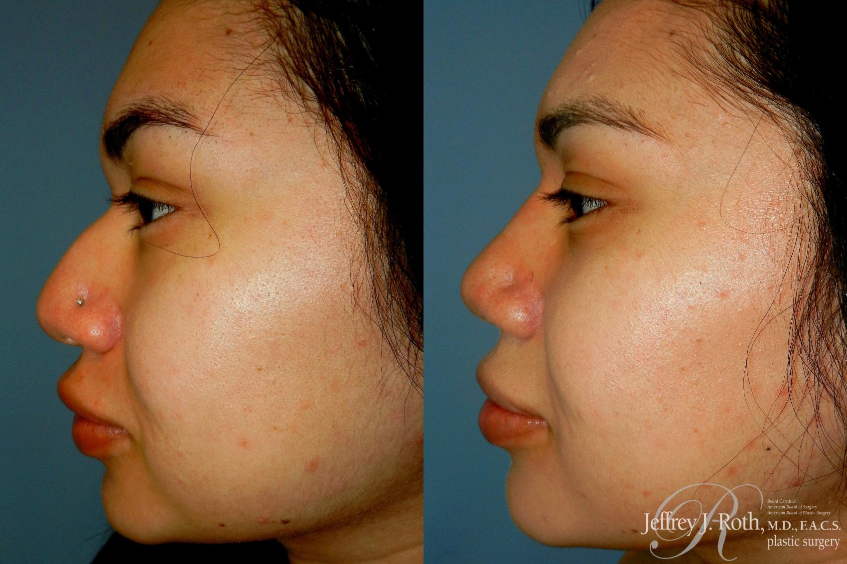 Rhinoplasty result at Jeffrey J. Roth, MD Plastic Surgery