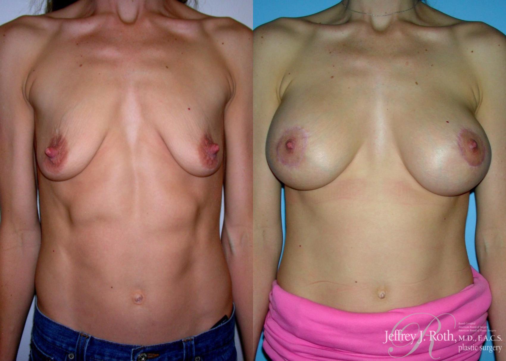 Breast Lift result at Jeffrey J. Roth, MD Plastic Surgery
