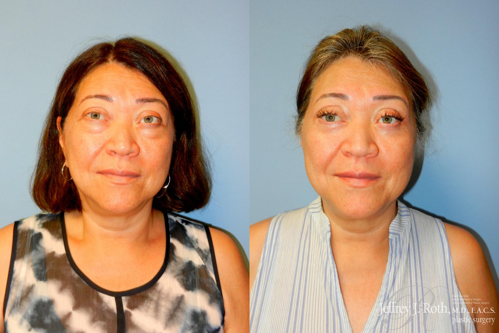 Blepharoplasty result at Jeffrey J. Roth, MD Plastic Surgery