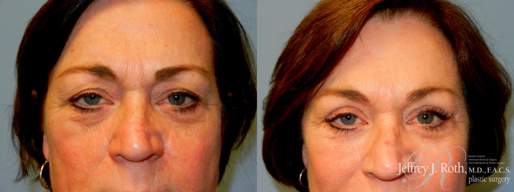 Blepharoplasty result at Jeffrey J. Roth, MD Plastic Surgery