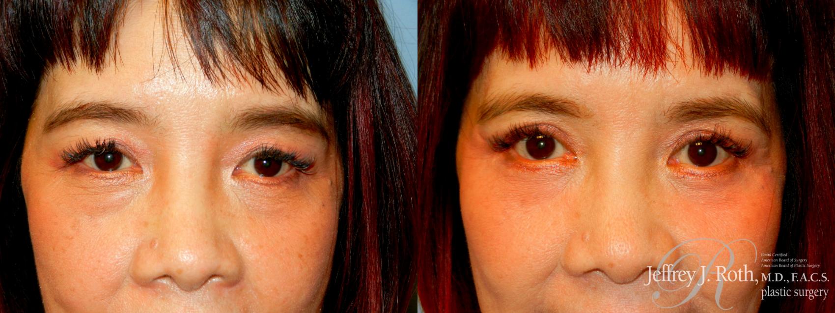 Blepharoplasty result at Jeffrey J. Roth, MD Plastic Surgery