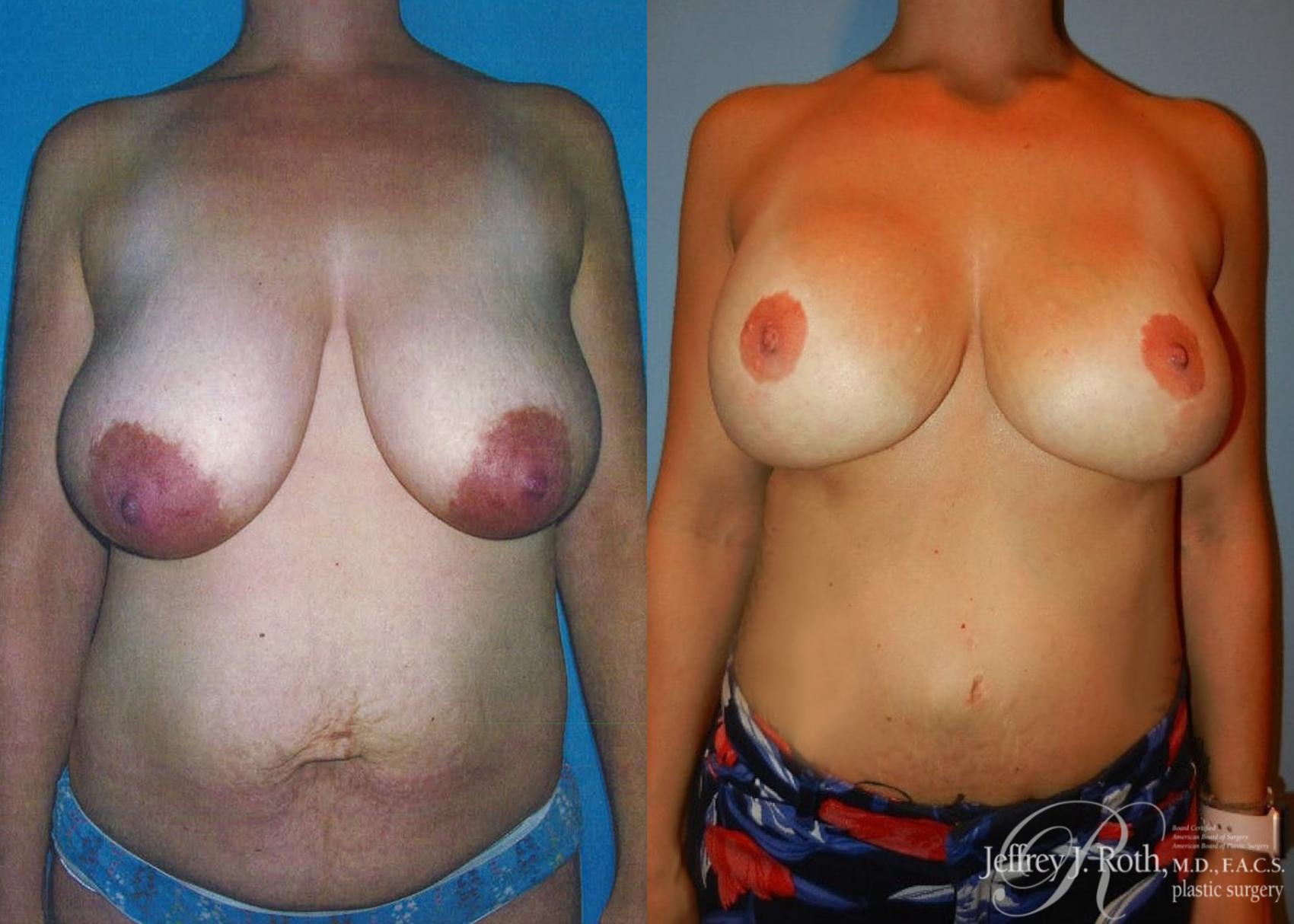 Mommy Makeover result at Jeffrey J. Roth, MD Plastic Surgery