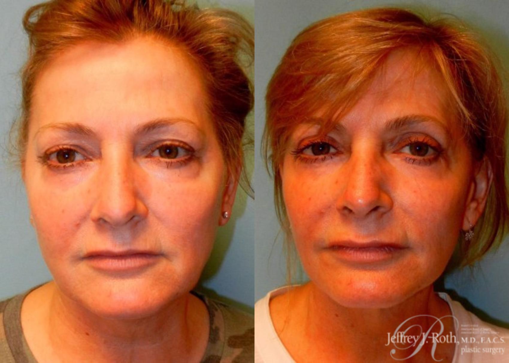 Facelift result at Jeffrey J. Roth, MD Plastic Surgery