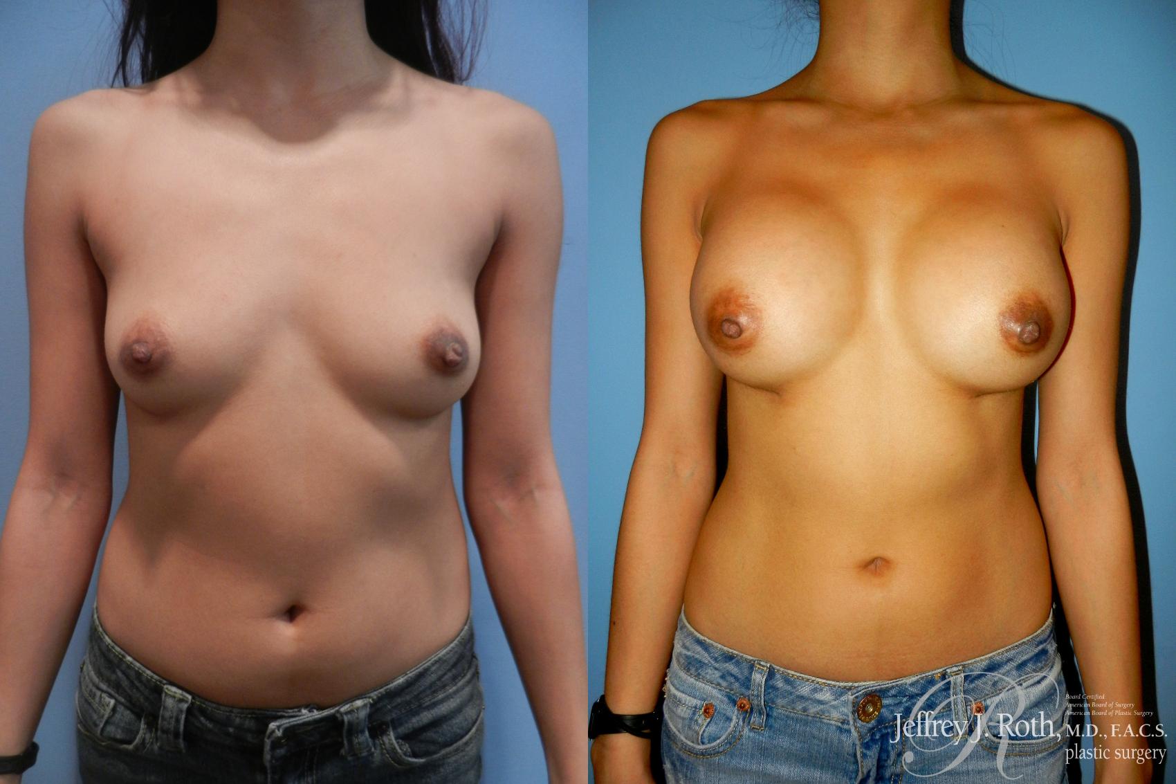 Breast Augmentation result at Jeffrey J. Roth, MD Plastic Surgery