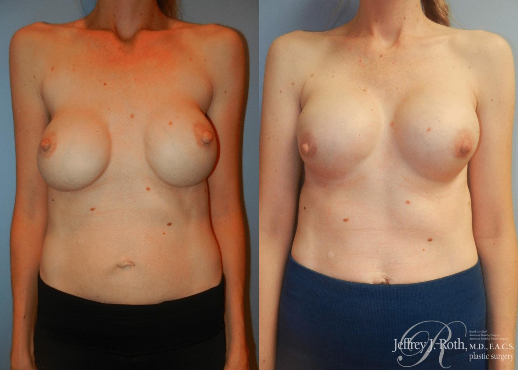 Implant Revision result at Jeffrey J. Roth, MD Plastic Surgery