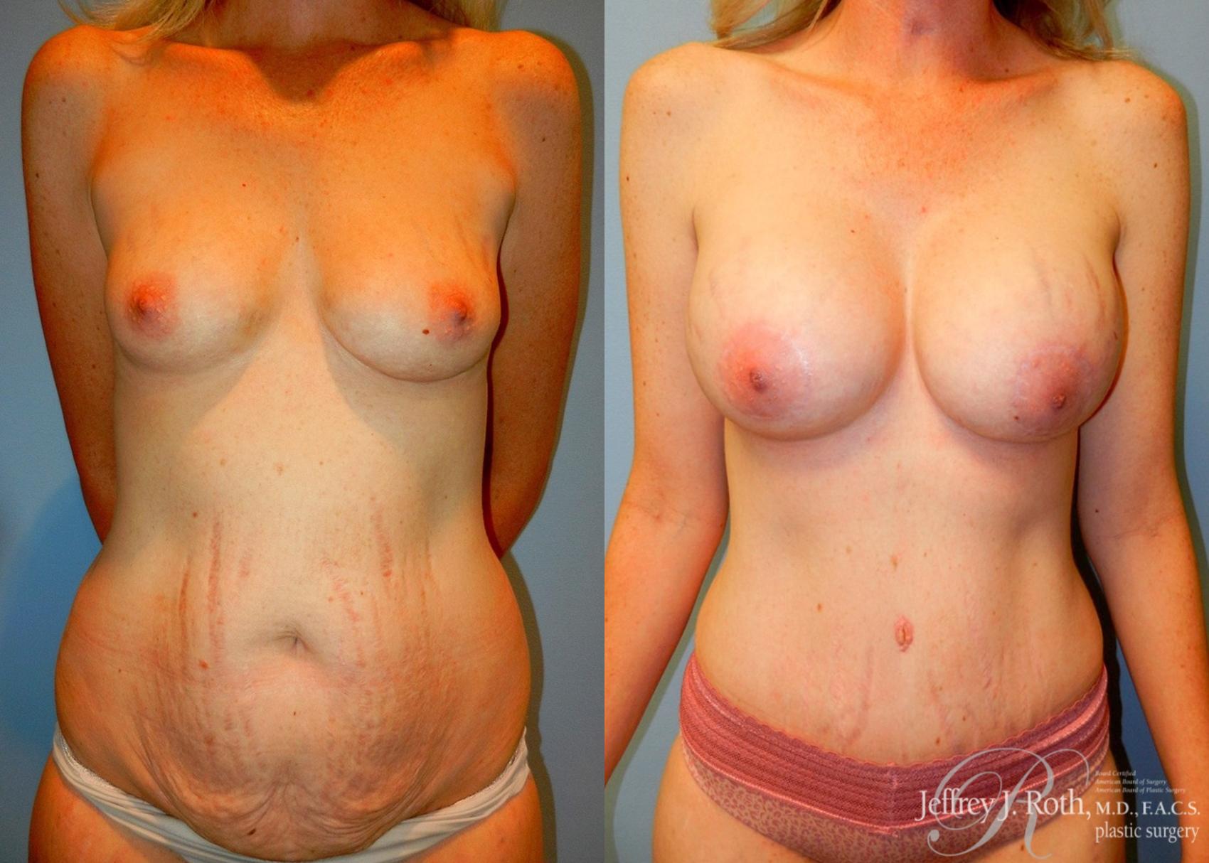 Mommy Makeover result at Jeffrey J. Roth, MD Plastic Surgery