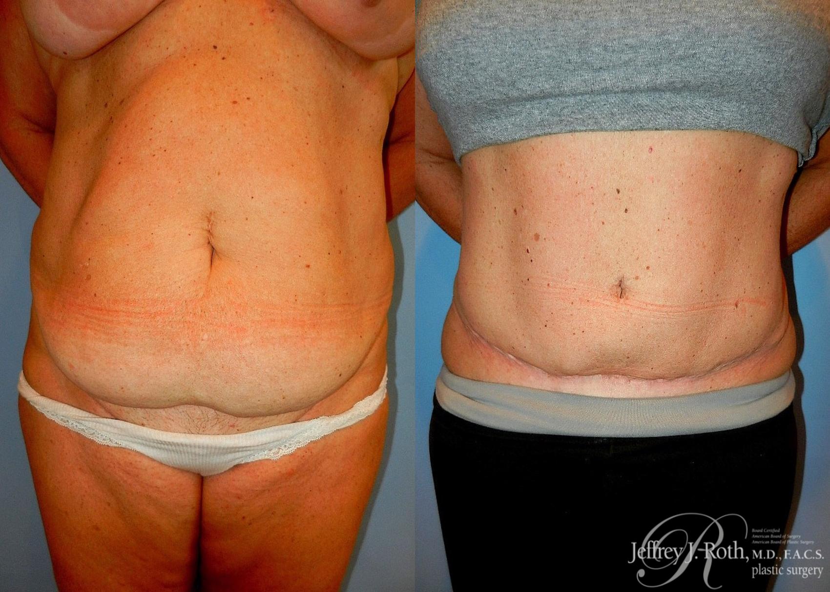 Tummy Tuck result at Jeffrey J. Roth, MD Plastic Surgery