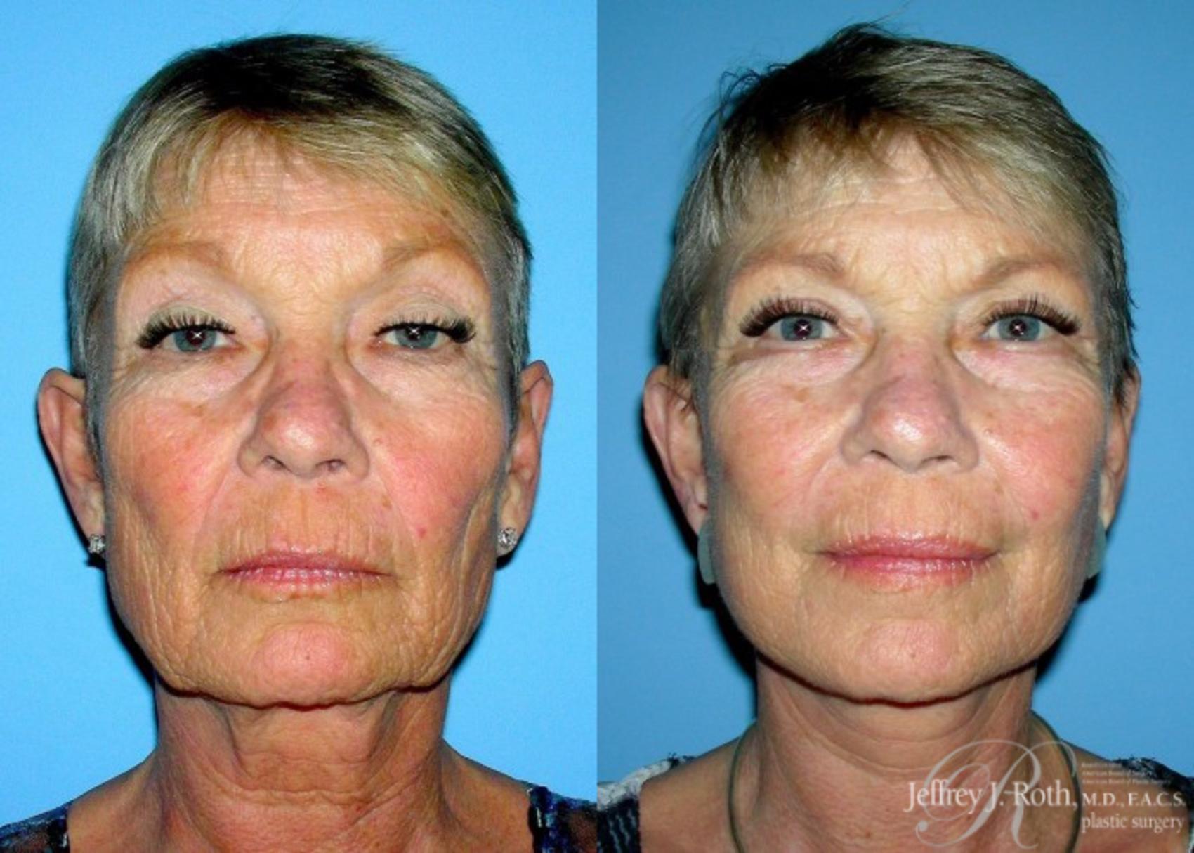 Facelift result at Jeffrey J. Roth, MD Plastic Surgery