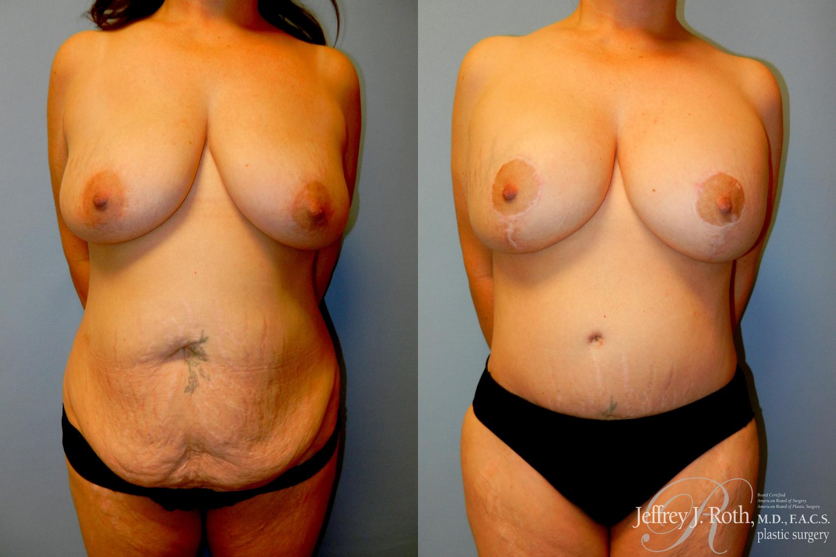 Breast Lift result at Jeffrey J. Roth, MD Plastic Surgery