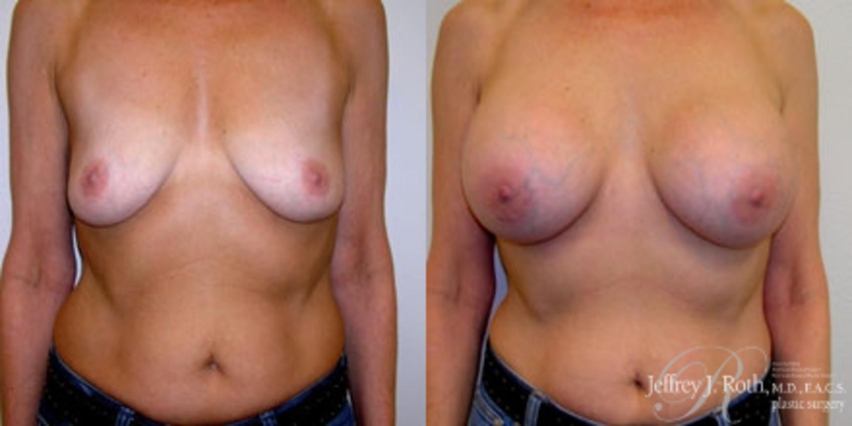 Breast Augmentation result at Jeffrey J. Roth, MD Plastic Surgery