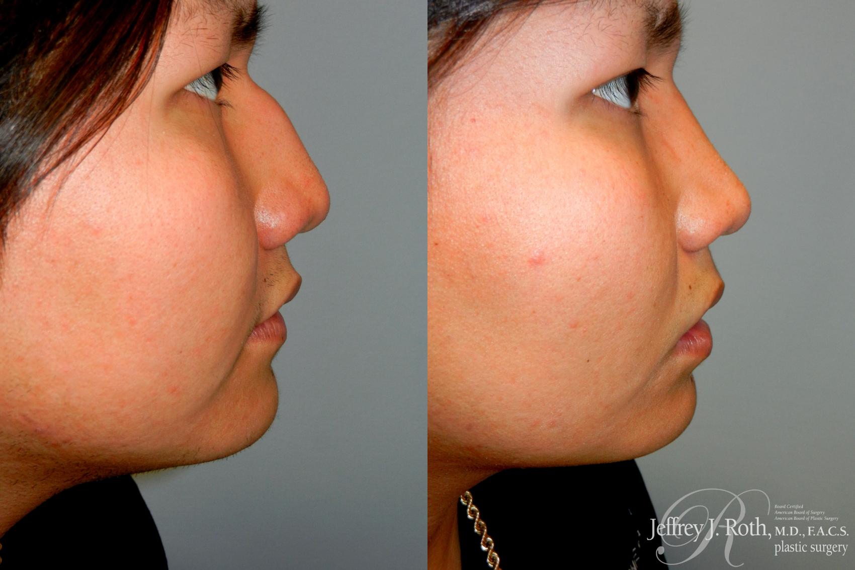 Rhinoplasty result at Jeffrey J. Roth, MD Plastic Surgery
