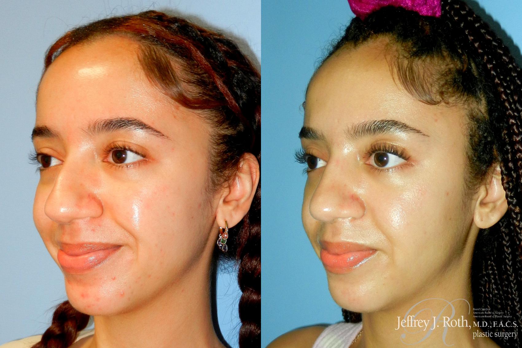 Rhinoplasty result at Jeffrey J. Roth, MD Plastic Surgery