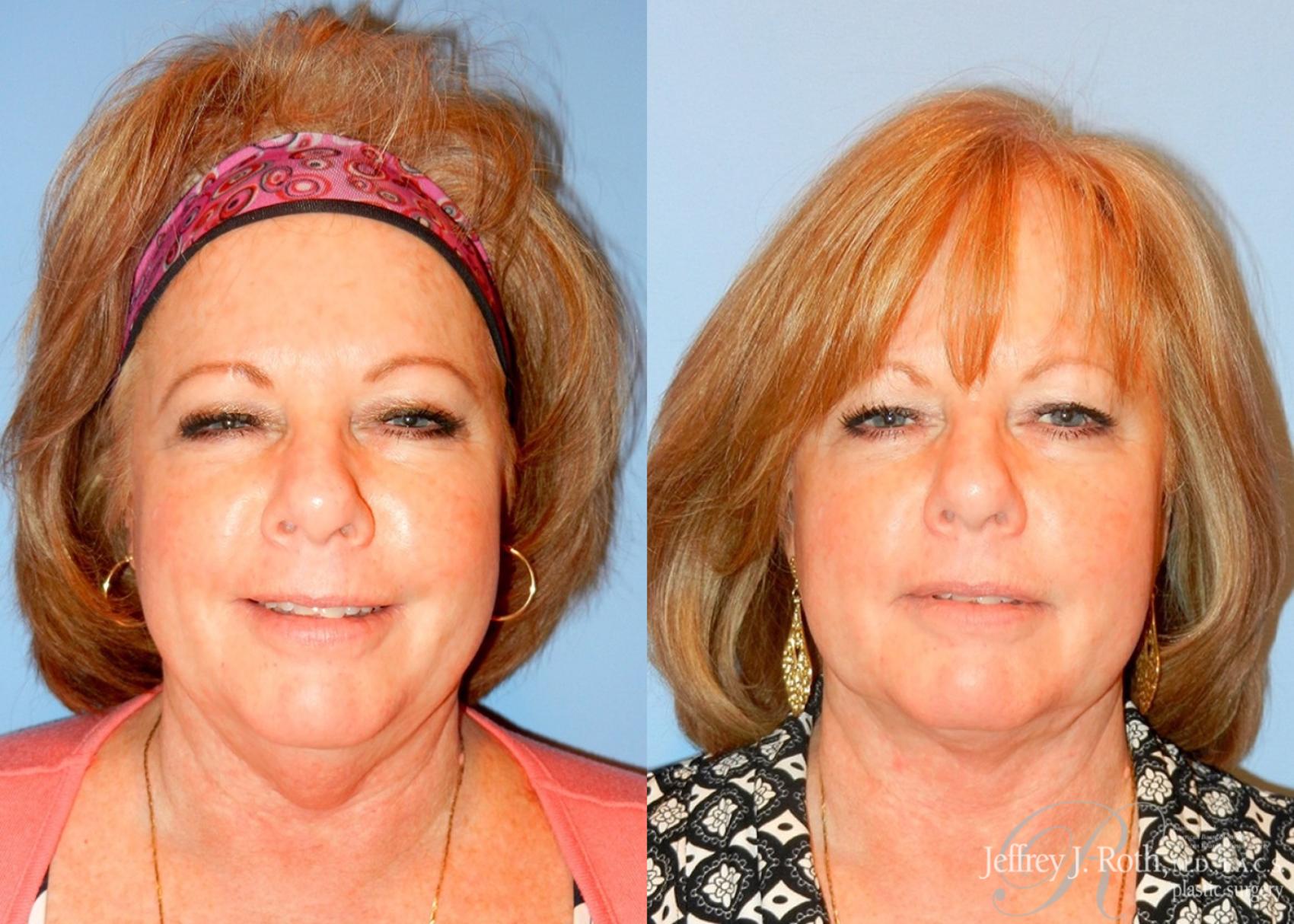 Liposuction result at Jeffrey J. Roth, MD Plastic Surgery
