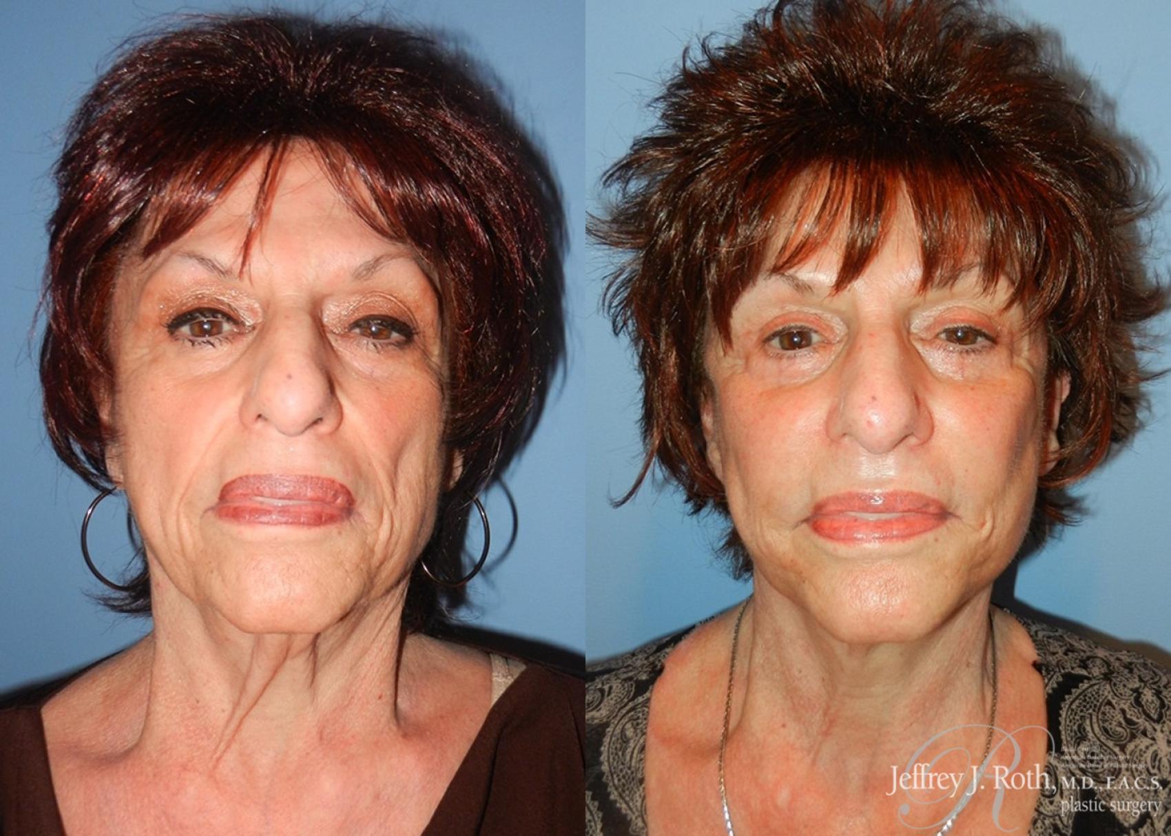 Facelift result at Jeffrey J. Roth, MD Plastic Surgery