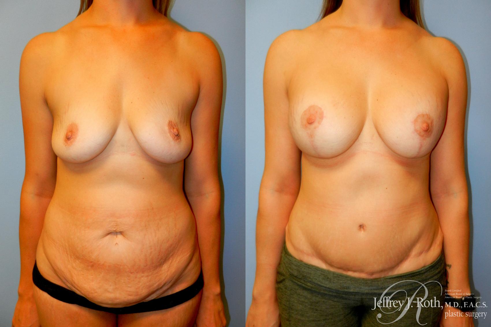 Tummy Tuck result at Jeffrey J. Roth, MD Plastic Surgery