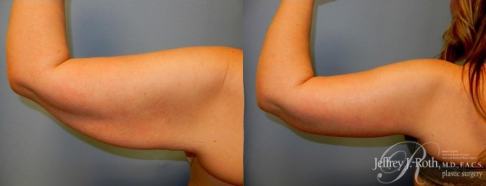 Body Contouring result at Jeffrey J. Roth, MD Plastic Surgery