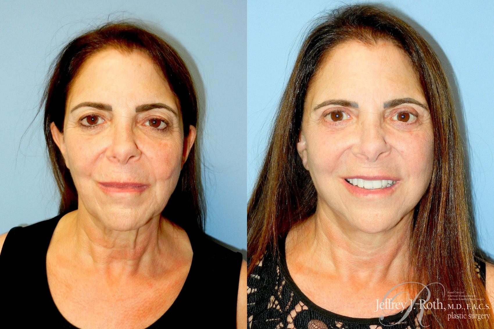 Facelift result at Jeffrey J. Roth, MD Plastic Surgery