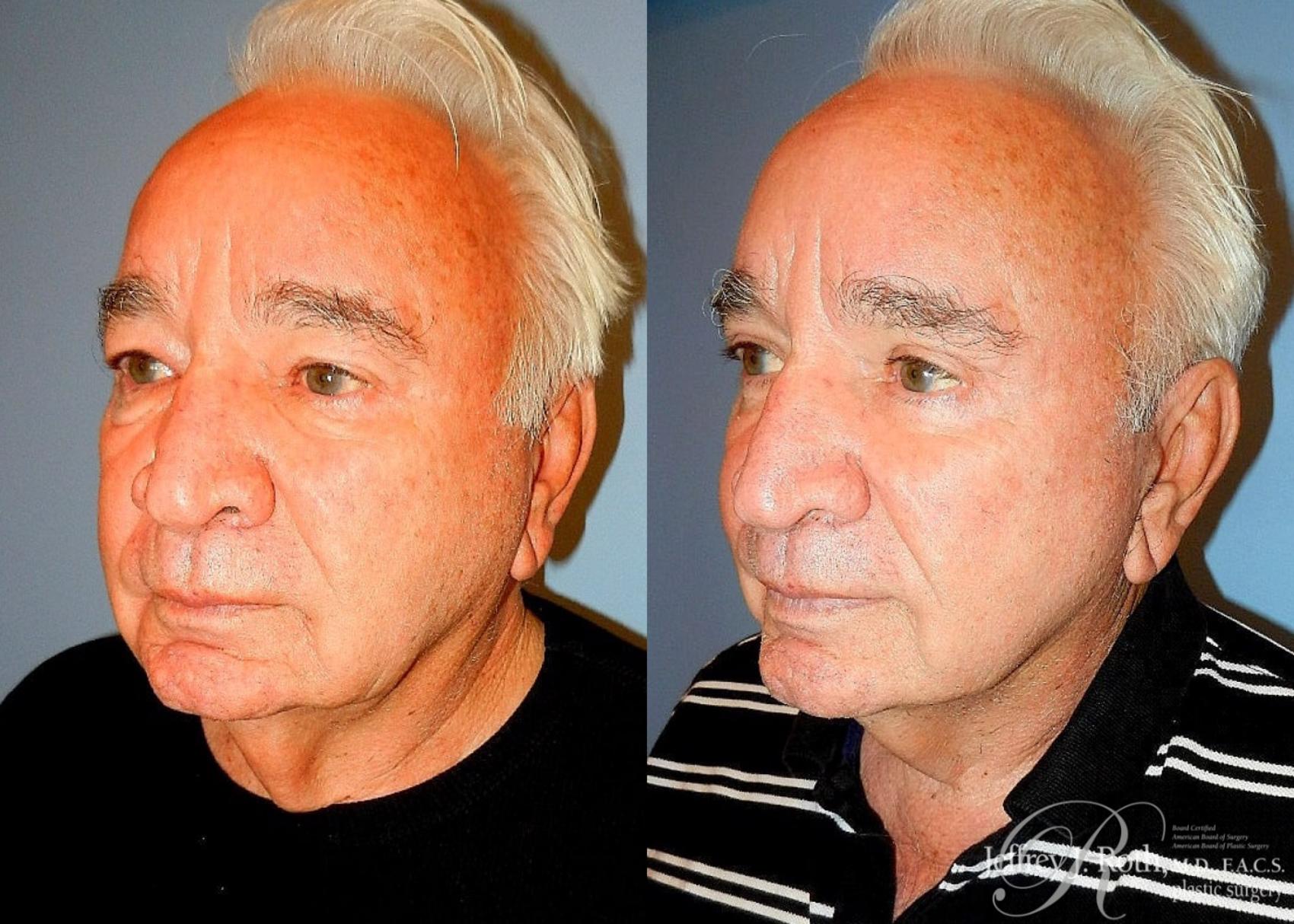 Facelift result at Jeffrey J. Roth, MD Plastic Surgery