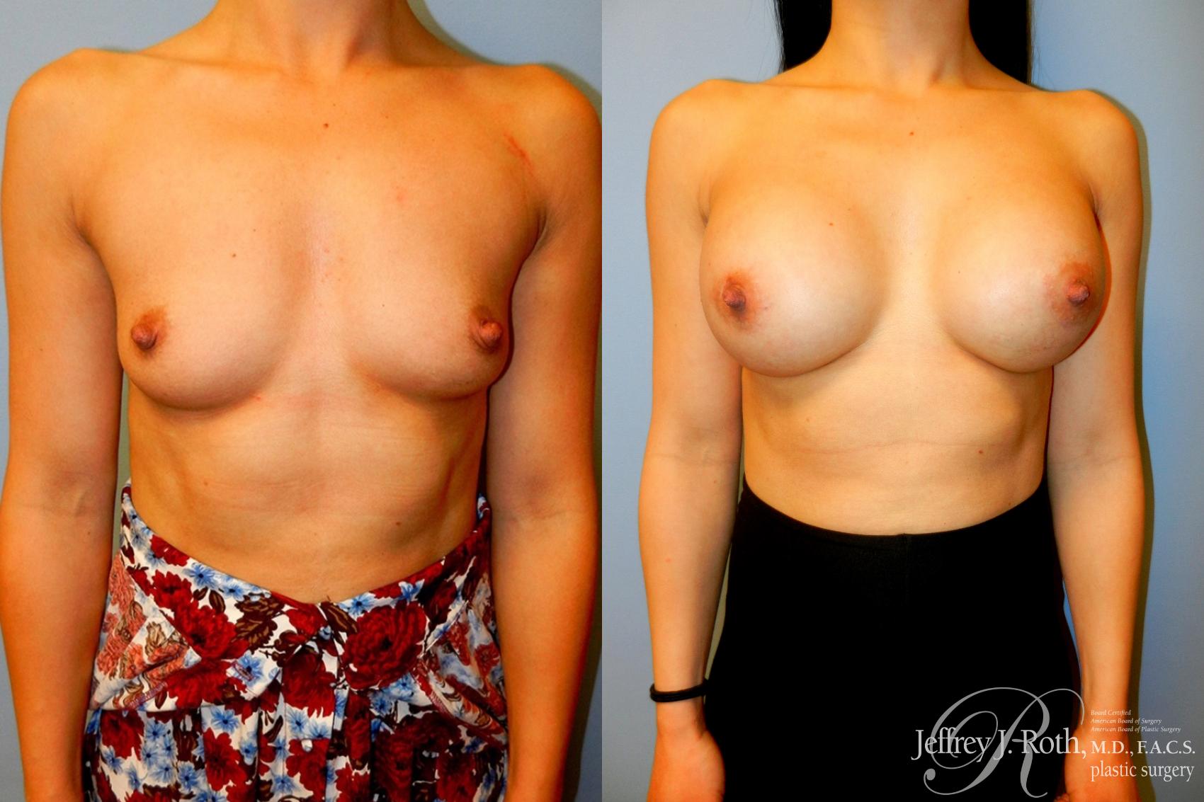 Breast Augmentation result at Jeffrey J. Roth, MD Plastic Surgery