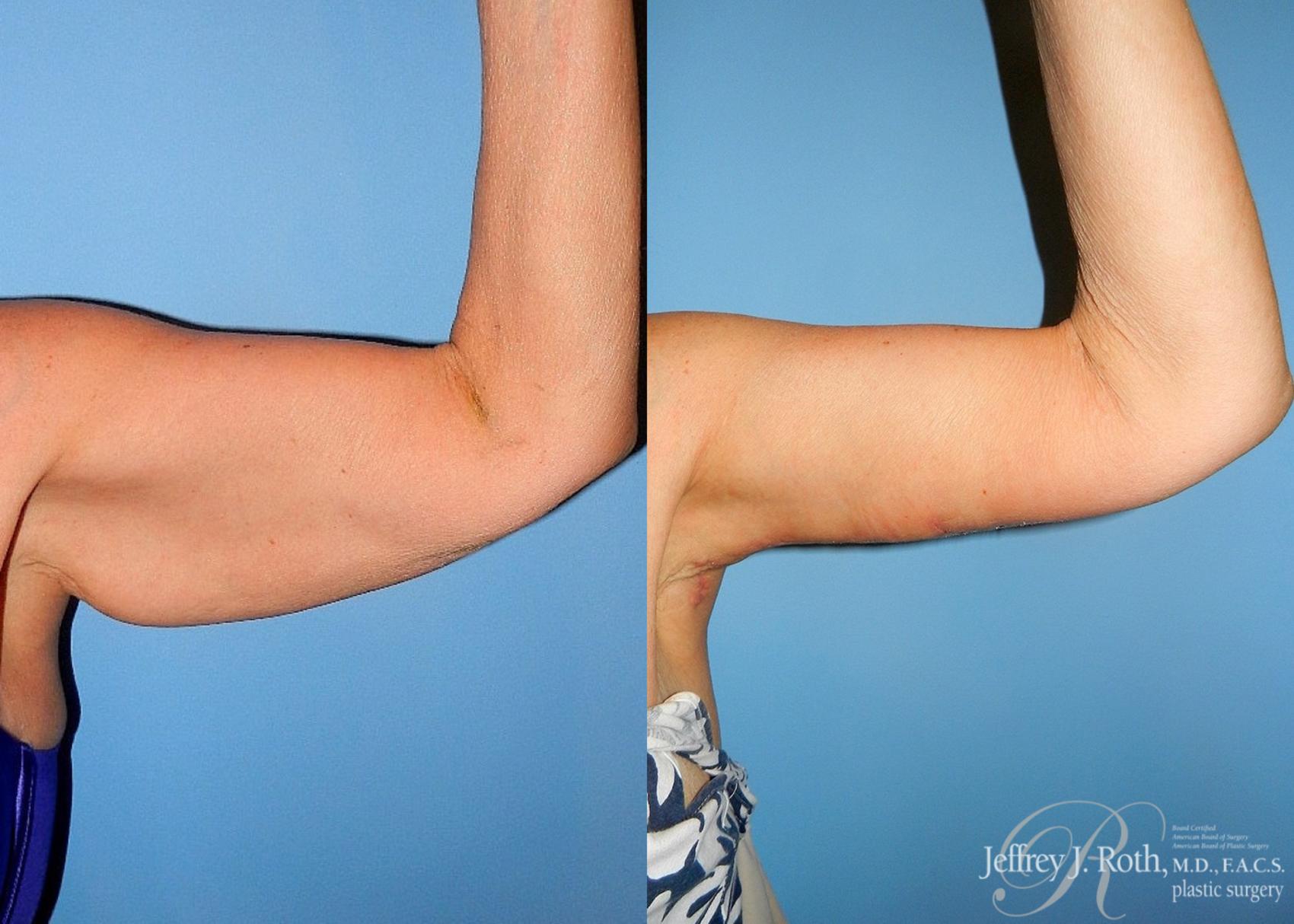 Body Contouring result at Jeffrey J. Roth, MD Plastic Surgery