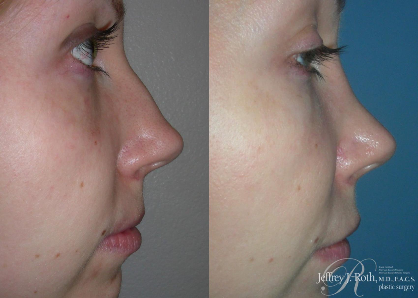 Rhinoplasty result at Jeffrey J. Roth, MD Plastic Surgery
